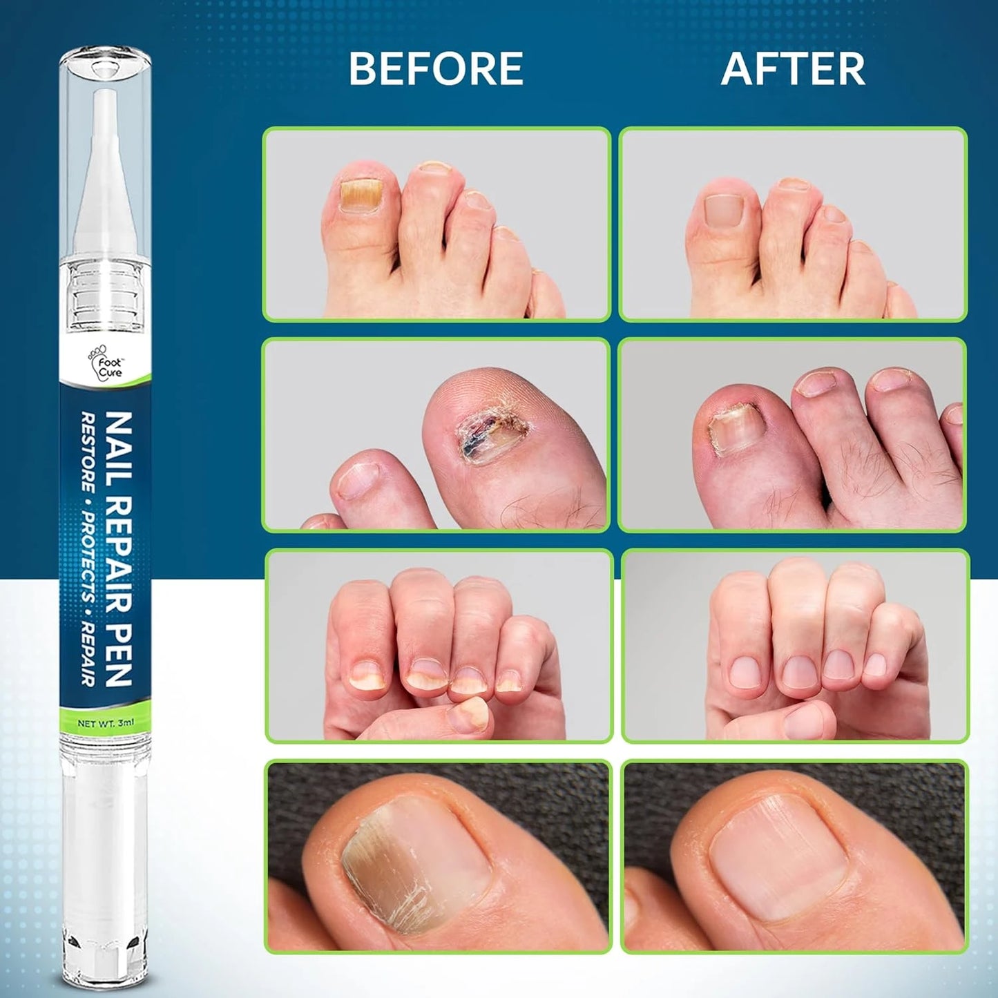 Toenail Fungus Treatment Extra Strength - Pen 4 pack