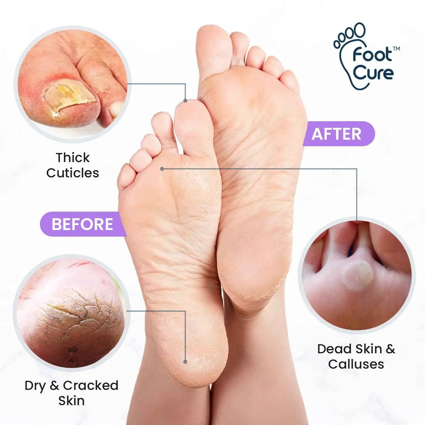 Lavender Foot Soak & Callus Remover Gel Kit Foot Cure