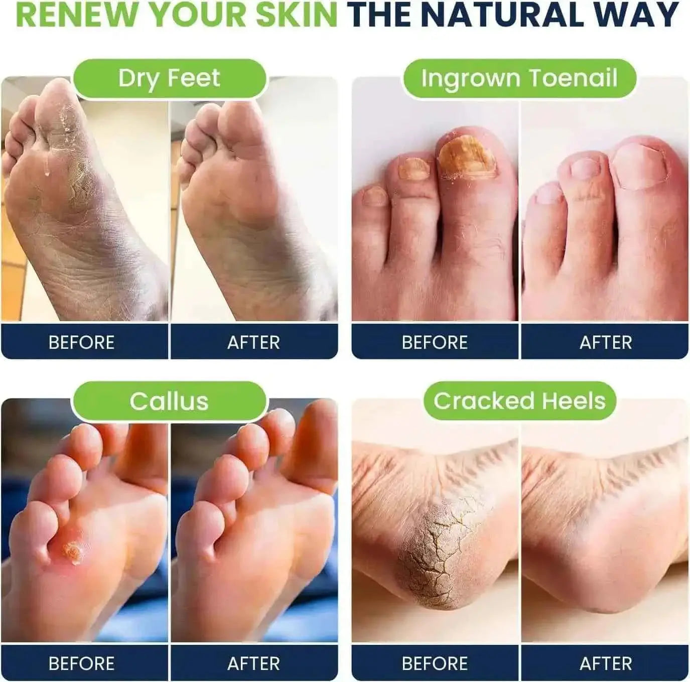 Tea Tree Oil & Citrus Detox Foot Soak with Epsom Salts (Pack of 2) Foot Cure