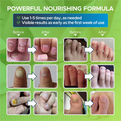 Toenail Fungus Treatment Extra Strength - Fungal Nail Treatment for Toe Nail & Fingernails - Nail Repair Solution for Thick, broken, Discolored Nails - Renews Damaged ed Ingrown Toenail - Pen 4 pack