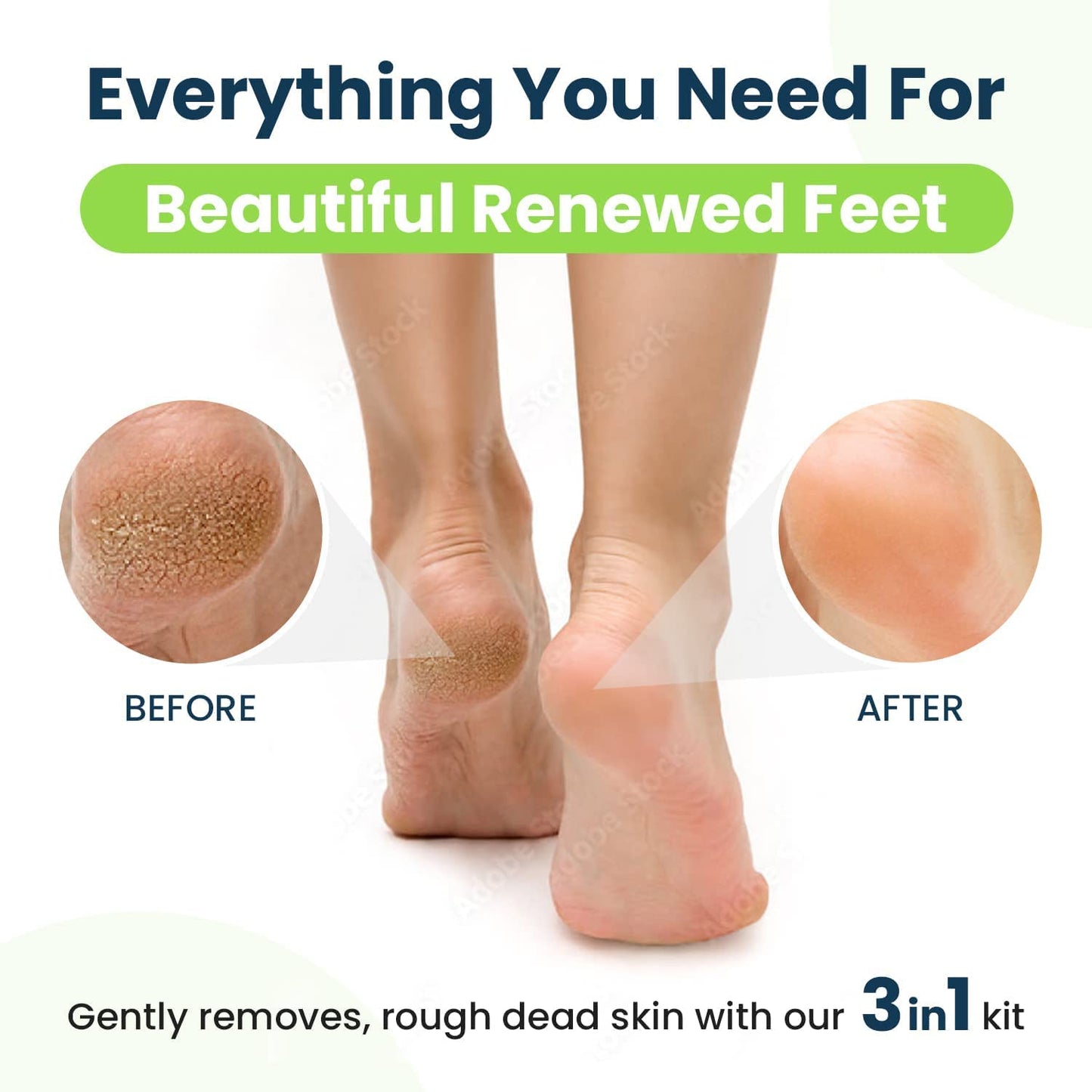 Callus Remover for Feet with Extra Strength Gel & Foot Pumice Stone Set