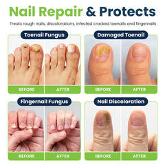 Toenail Fungus Treatment Extra Strength - Fungal Nail Treatment for Toe Nail & Fingernails - Nail Repair Solution for Thick, broken, Discolored Nails - Renews Damaged ed Ingrown Toenail - Pen 4 pack