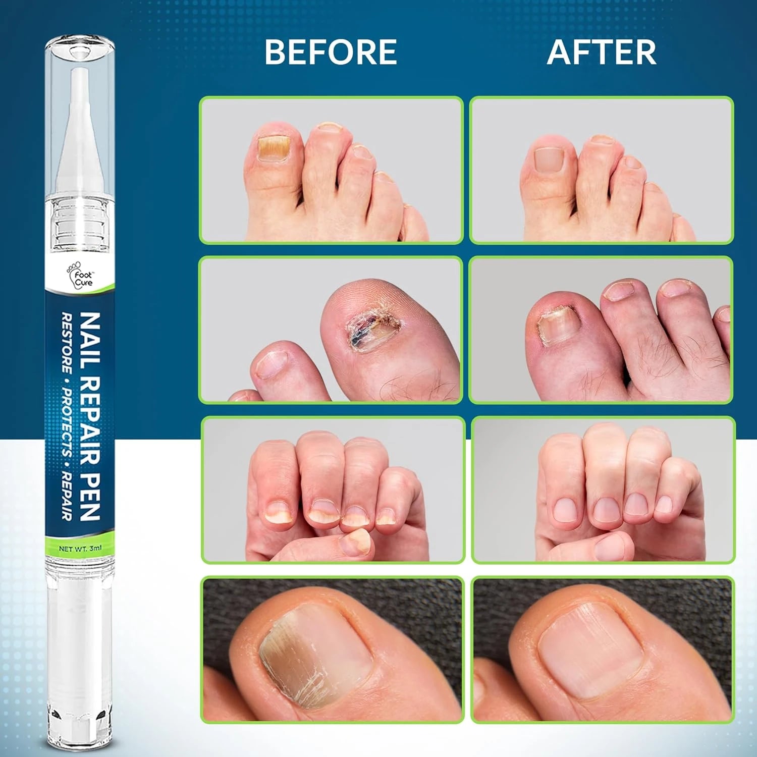 Toenail Fungus Treatment Extra Strength - Pen 4 pack – Foot Cure