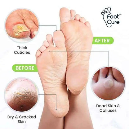 Foot Soak & Callus Remover Gel Kit Foot Cure