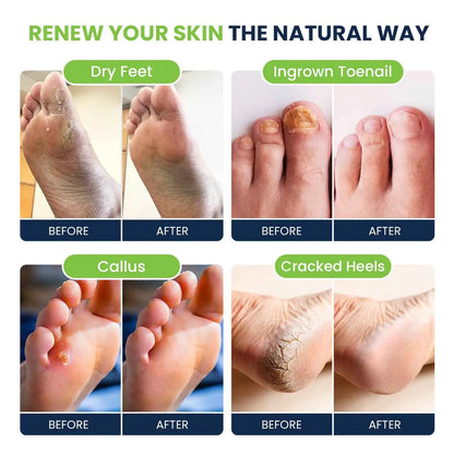 Foot Soak with Epsom Salts- Variety Pack of 4 Foot Cure