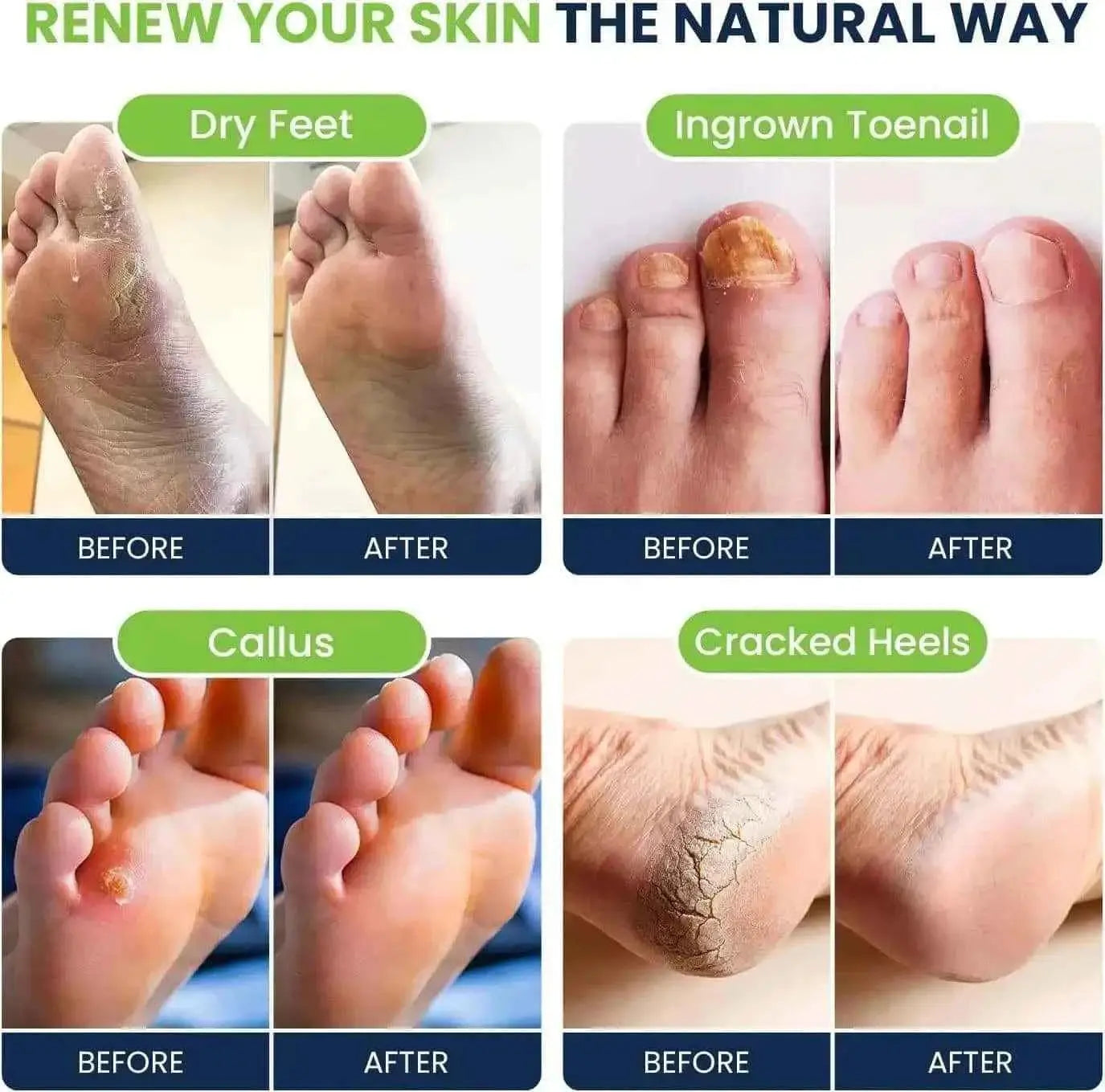 Tea Tree Oil Foot Soak with Epsom Salts 4 Pack Foot Cure